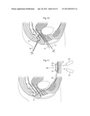 VAGINAL OPERATION METHOD FOR THE TREATMENT OF ANAL INCONTINENCE IN WOMEN diagram and image