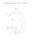 VAGINAL OPERATION METHOD FOR THE TREATMENT OF ANAL INCONTINENCE IN WOMEN diagram and image