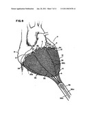 Delivery of cardiac constraint jacket diagram and image