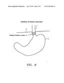 METHODS AND APPARATUS FOR TREATMENT OF OBESITY diagram and image