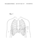 TRANSAPICAL DELIVERY SYSTEM FOR HEART VALVES diagram and image