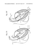 TRANSAPICAL DELIVERY SYSTEM FOR HEART VALVES diagram and image