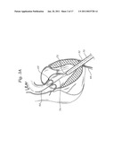 TRANSAPICAL DELIVERY SYSTEM FOR HEART VALVES diagram and image