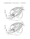 TRANSAPICAL DELIVERY SYSTEM FOR HEART VALVES diagram and image