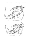 TRANSAPICAL DELIVERY SYSTEM FOR HEART VALVES diagram and image