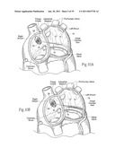 Devices, systems, and methods for reshaping a heart valve annulus, including the use of magnetic tools diagram and image