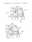 Devices, systems, and methods for reshaping a heart valve annulus, including the use of magnetic tools diagram and image