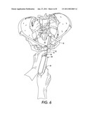 SINGLE-INCISION MINIMALLY-INVASIVE SURGICAL REPAIR OF PELVIC ORGAN/VAGINAL PROLAPSE CONDITIONS diagram and image