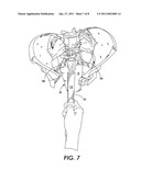 SINGLE-INCISION MINIMALLY-INVASIVE SURGICAL REPAIR OF PELVIC ORGAN/VAGINAL PROLAPSE CONDITIONS diagram and image