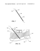 USE OF FOCUSED ULTRASOUND FOR VASCULAR SEALING diagram and image