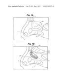 Devices and methods for minimally invasive access to sinuses and treatment of sinusitis diagram and image