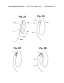 Devices and methods for minimally invasive access to sinuses and treatment of sinusitis diagram and image