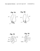 Devices and methods for minimally invasive access to sinuses and treatment of sinusitis diagram and image