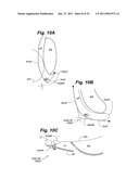 Devices and methods for minimally invasive access to sinuses and treatment of sinusitis diagram and image