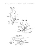 Devices and methods for minimally invasive access to sinuses and treatment of sinusitis diagram and image