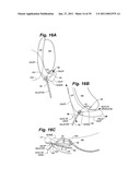 Devices and methods for minimally invasive access to sinuses and treatment of sinusitis diagram and image