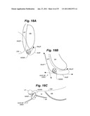 Devices and methods for minimally invasive access to sinuses and treatment of sinusitis diagram and image