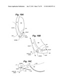 Devices and methods for minimally invasive access to sinuses and treatment of sinusitis diagram and image