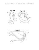 Devices and methods for minimally invasive access to sinuses and treatment of sinusitis diagram and image