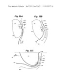 Devices and methods for minimally invasive access to sinuses and treatment of sinusitis diagram and image