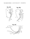 Devices and methods for minimally invasive access to sinuses and treatment of sinusitis diagram and image