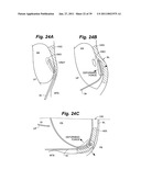 Devices and methods for minimally invasive access to sinuses and treatment of sinusitis diagram and image