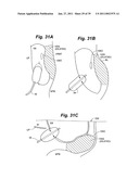 Devices and methods for minimally invasive access to sinuses and treatment of sinusitis diagram and image