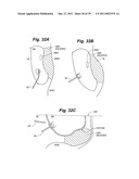 Devices and methods for minimally invasive access to sinuses and treatment of sinusitis diagram and image