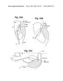 Devices and methods for minimally invasive access to sinuses and treatment of sinusitis diagram and image