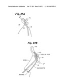 Devices and methods for minimally invasive access to sinuses and treatment of sinusitis diagram and image