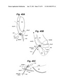 Devices and methods for minimally invasive access to sinuses and treatment of sinusitis diagram and image