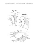 Devices and methods for minimally invasive access to sinuses and treatment of sinusitis diagram and image