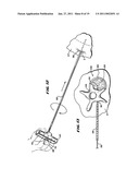 SYSTEMS AND METHODS FOR PLACING MATERIALS INTO BONE diagram and image