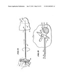 SYSTEMS AND METHODS FOR PLACING MATERIALS INTO BONE diagram and image