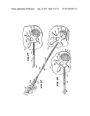 SYSTEMS AND METHODS FOR PLACING MATERIALS INTO BONE diagram and image