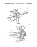 MEDICAL DEVICE FOR MODIFICATION OF LEFT ATRIAL APPENDAGE AND RELATED SYSTEMS AND METHODS diagram and image