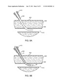 HEMOSTASIS-ENHANCING DEVICE AND METHOD FOR ITS USE diagram and image