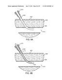 HEMOSTASIS-ENHANCING DEVICE AND METHOD FOR ITS USE diagram and image