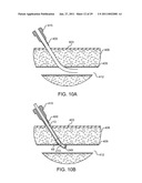 HEMOSTASIS-ENHANCING DEVICE AND METHOD FOR ITS USE diagram and image