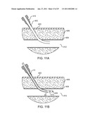 HEMOSTASIS-ENHANCING DEVICE AND METHOD FOR ITS USE diagram and image