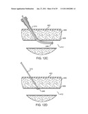 HEMOSTASIS-ENHANCING DEVICE AND METHOD FOR ITS USE diagram and image