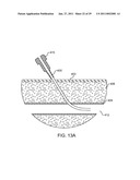 HEMOSTASIS-ENHANCING DEVICE AND METHOD FOR ITS USE diagram and image