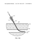 HEMOSTASIS-ENHANCING DEVICE AND METHOD FOR ITS USE diagram and image