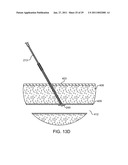 HEMOSTASIS-ENHANCING DEVICE AND METHOD FOR ITS USE diagram and image