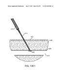 HEMOSTASIS-ENHANCING DEVICE AND METHOD FOR ITS USE diagram and image