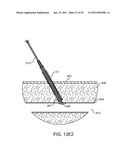 HEMOSTASIS-ENHANCING DEVICE AND METHOD FOR ITS USE diagram and image