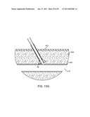 HEMOSTASIS-ENHANCING DEVICE AND METHOD FOR ITS USE diagram and image