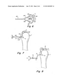 SUTURE FIXATION DEVICE AND METHOD FOR SURGICAL REPAIR diagram and image