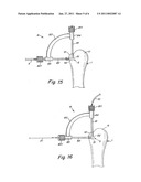 SUTURE FIXATION DEVICE AND METHOD FOR SURGICAL REPAIR diagram and image