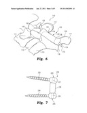 LOCAL DELIVERY OF AN ACTIVE AGENT FROM AN ORTHOPEDIC IMPLANT diagram and image
